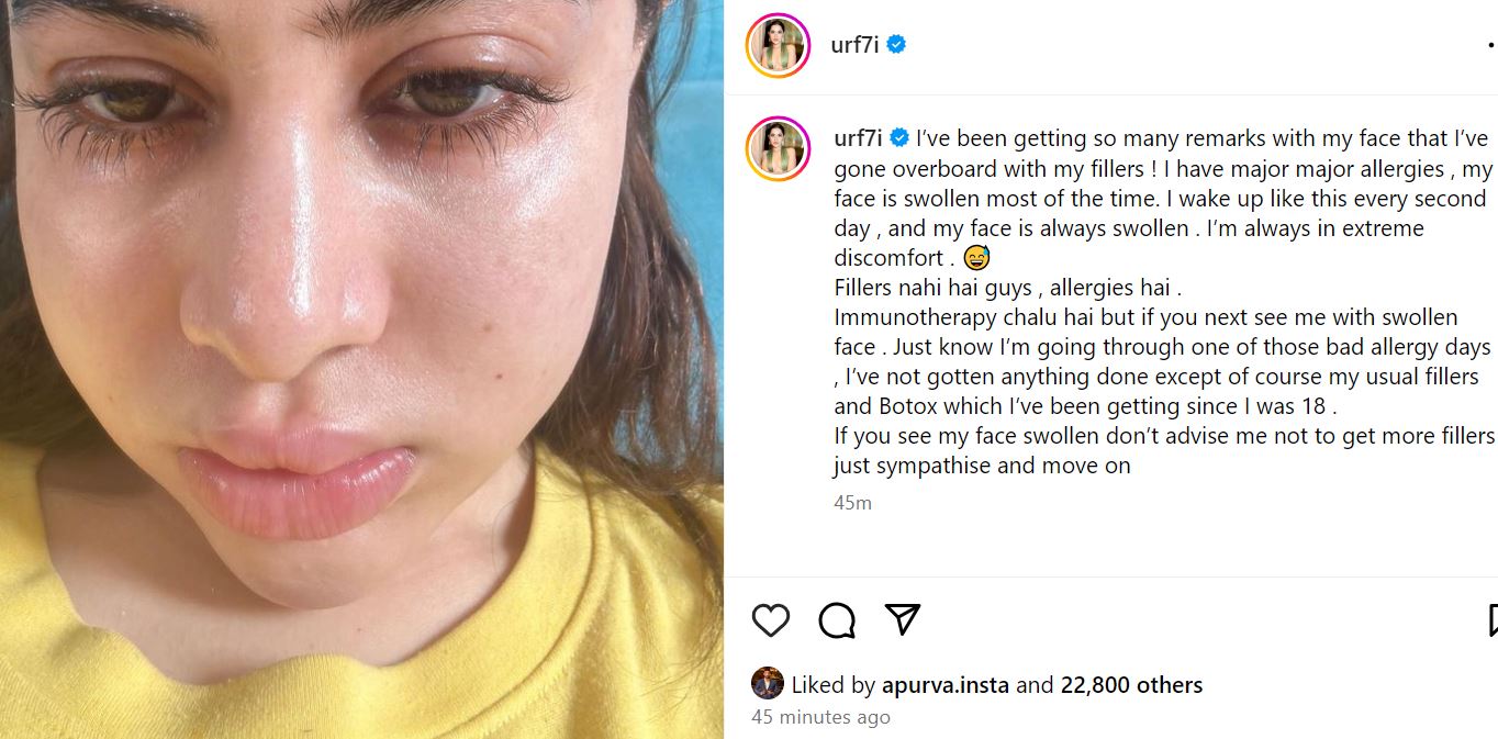 Urfi Javed Face Allergy. Photos